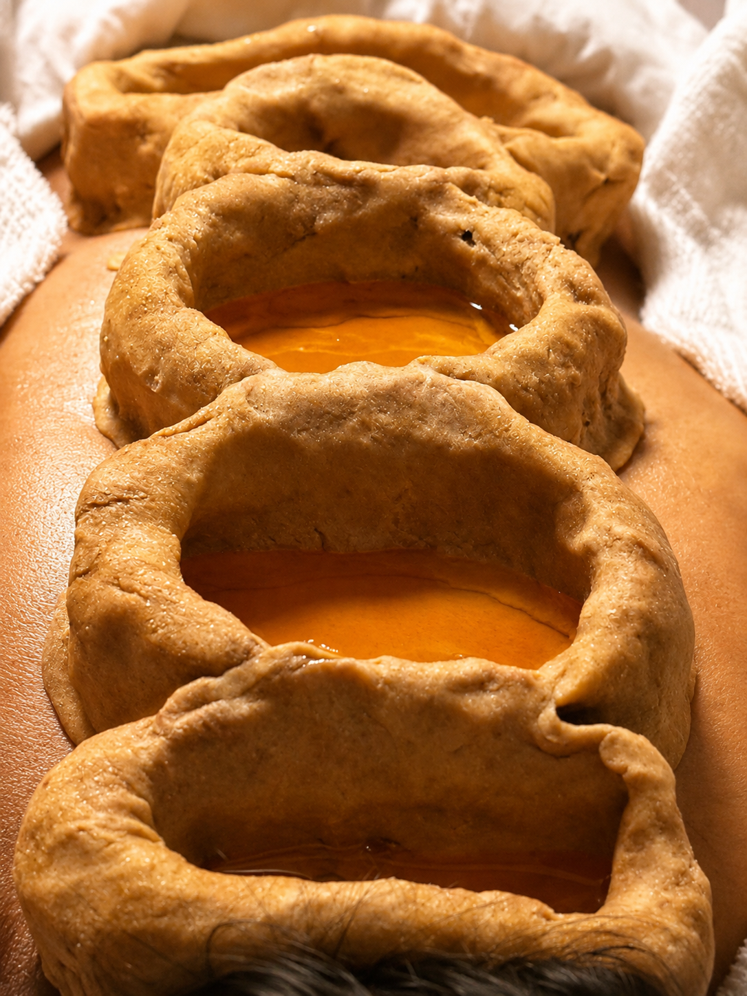 External Basti dough rings filled with warm herbal oil along the spine